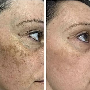 Observ Skin Analysis &ndash; Body Beautiful Retreat &ndash; Brisbane