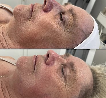 Observ Skin Analysis – Body Beautiful Retreat – Brisbane