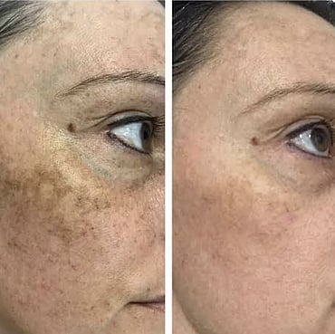 Observ Skin Analysis – Body Beautiful Retreat – Brisbane