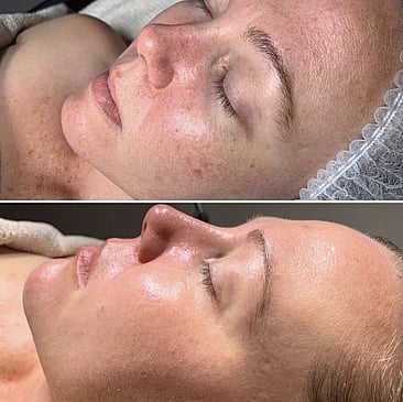 Observ Skin Analysis &ndash; Body Beautiful Retreat &ndash; Brisbane
