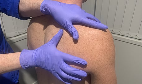 MCD FROZEN SHOULDER