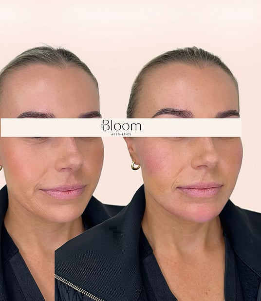Before and after dermal filler results of a Bloom Aesthetics client