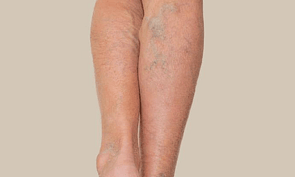 Bruising & Varicose Veins