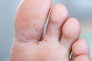 Athlete's Foot