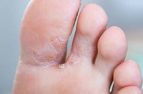 Athlete's Foot