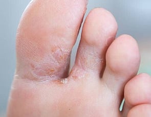 Athlete's Foot