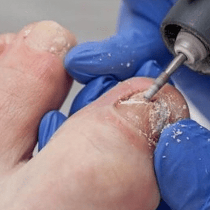 Ingrown Toenail Solutions