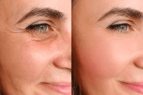 Skin Aging