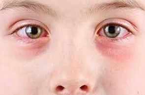 Eye Allergies