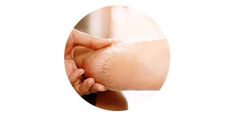 Cracked heel treatment Hamilton