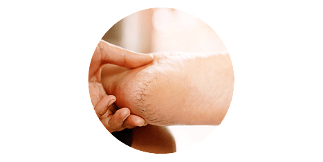 Wart treatment