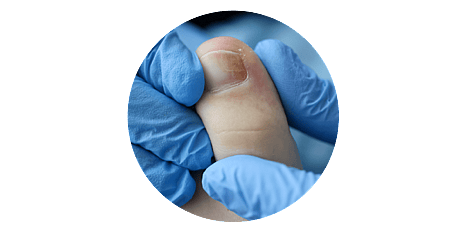 Ingrown Toenails
