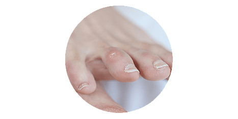 Corns or Callus