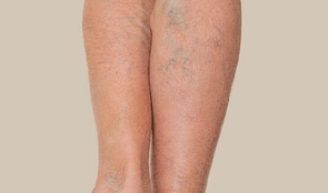 Bruising & Varicose Veins