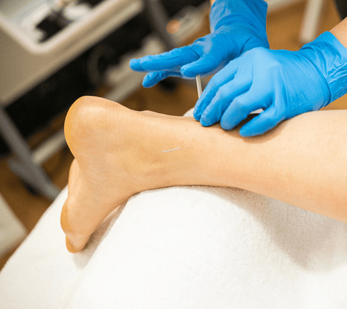 Dry Needling at Foot Foundation
