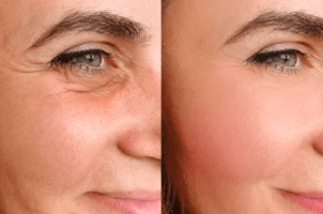 Skin Aging