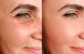 Skin Aging