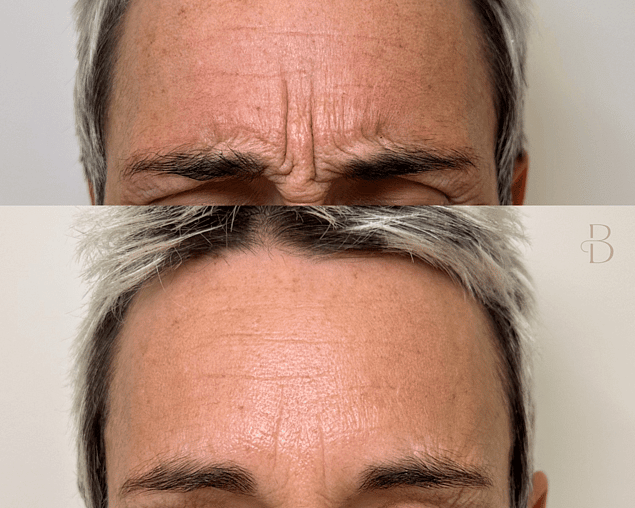 Before and after anti-wrinkle treatment for frown lines on a Bloom Aesthetics client 
