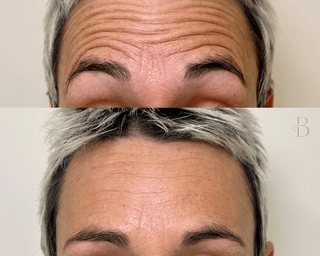Before and after anti-wrinkle treatment for forehead lines on a Bloom Aesthetics client 
