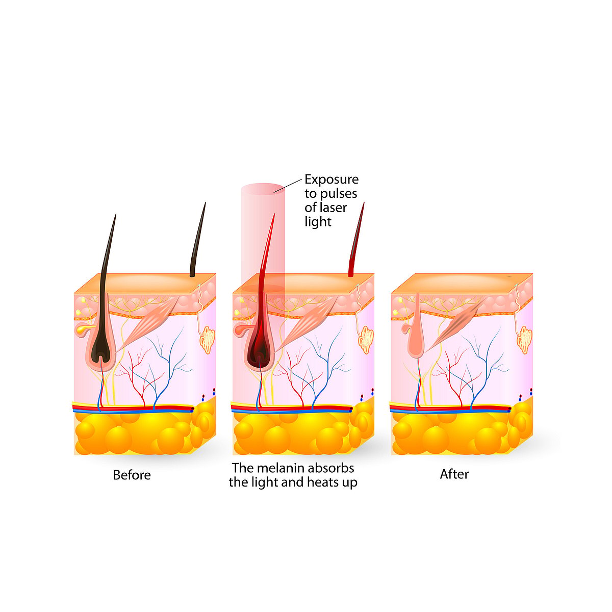 Laser Hair Removal Cambridge | Loulous Day Spa