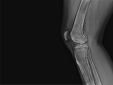 X-ray illustration of a side view of a human knee joint, showing the femur, tibia, and patella, against a dark background.