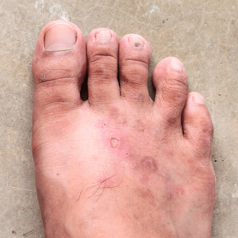 Specialist podiatry care for foot skin conditions including corns, calluses, warts, athlete’s foot, cracked heels, and dermatitis at Foot Foundation