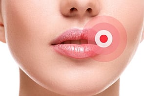 Cold Sores
