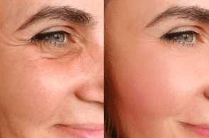 Skin Aging