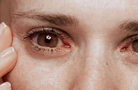 Eye Allergies