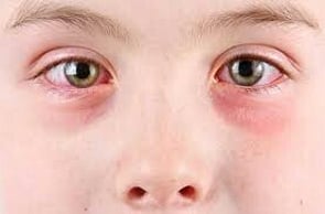 Eye Allergies