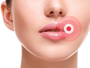 cold sores
