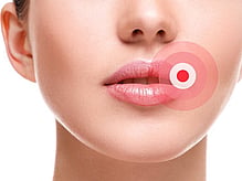 cold sores