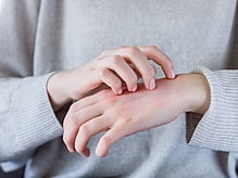 scabies