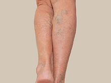 bruising & varicose veins