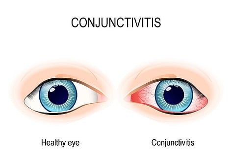 eye infections