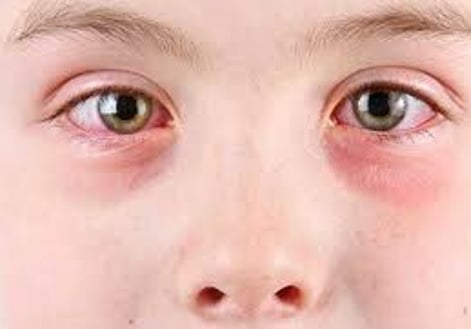 eye allergies
