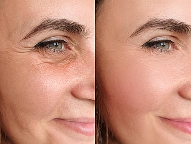 skin aging
