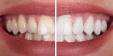 Teeth whitening