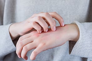 Scabies