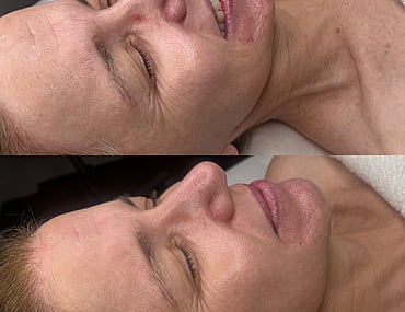 Observ Skin Analysis – Body Beautiful Retreat – Brisbane