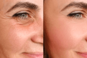 Skin Aging