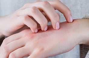 Scabies