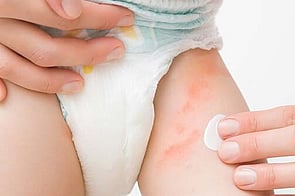 Nappy Rash