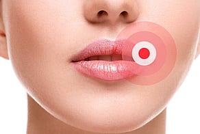 Cold Sores