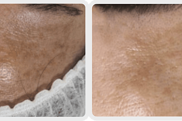 Observ Skin Analysis – Body Beautiful Retreat – Brisbane