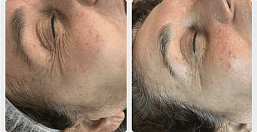Observ Skin Analysis &ndash; Body Beautiful Retreat &ndash; Brisbane