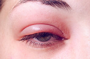 Eye Infections
