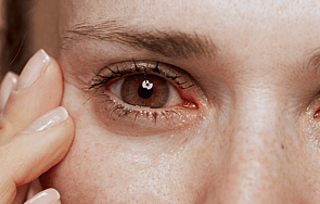 Eye Allergies