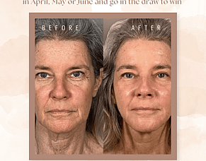 Invest in your skin to be in to win!  This April, May, June