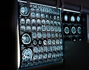 Hyperbaric Oxygen Therapy After Stroke:  Can Recovery Happen Even Years Later?